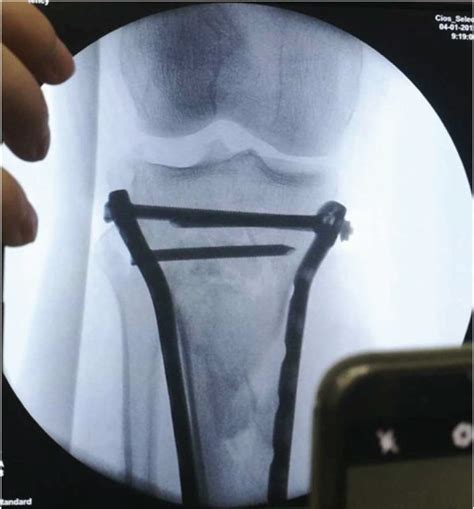 A 43 Year Old Male With Schatzker Type Vi Tibial Plateau Fracture With
