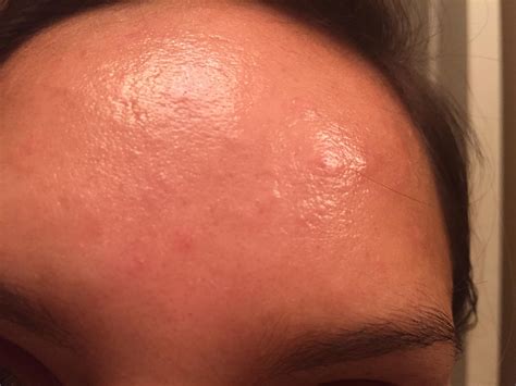 0 or rate as disfigurement of the head, face, or neck (dc 7800) or scars (dcs 7801, 7802, 7804, or 7805), depending upon the predominant disability 7829 chloracne: Closed Comedones - General acne discussion - Acne.org ...