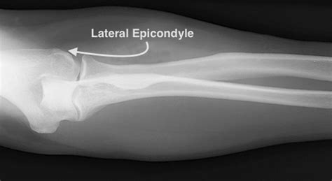 Lateral Epicondylitis X Ray