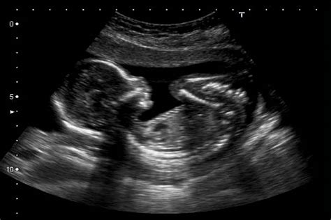 Ecografía Fetal En El Segundo Trimestre De Embarazo De Interés Para El