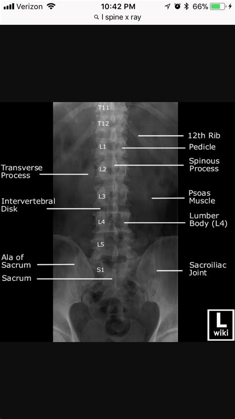 Ap Lumbar Spine Xray Radiology Tech Xray Tech Radiology Schools