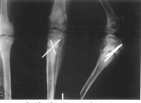 Figure 4 From Treatment Of Proximal Tibial Fractures By Cross Pin