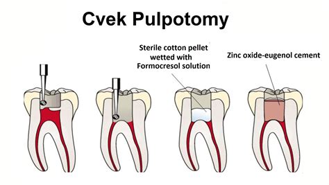 What Is Cvek Pulpotomy News Dentagama