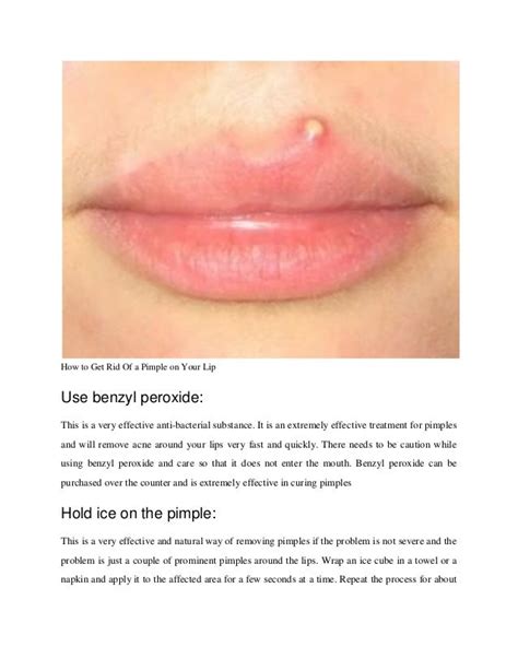 How To Get Rid Of Pimples On Lip Mang Temon
