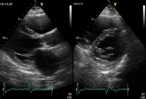 Echocardiogram Atrial Flutter With Av Block Dr Grepmed
