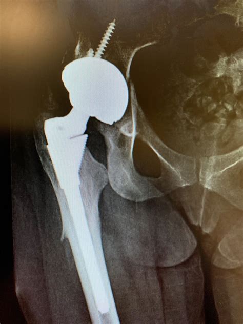 Case Study Acetabular Component Exchange In Hip Replacement
