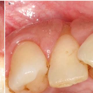 PDF Treatment Of An Advanced Gingival Recession Involving The Apex Of