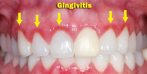 Gingivitis Symptoms Causes Treatment Cure Prevention Healthmd