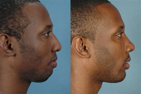 Male Nose Side Profile
