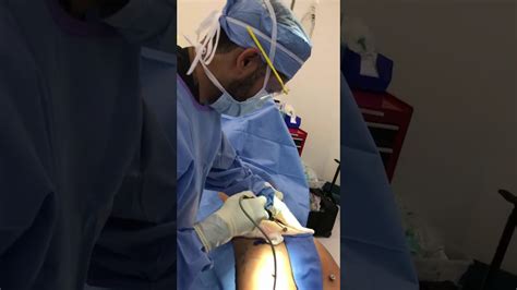 Brazilian Butt Lift Surgery Sculpting With Vaser Liposuction Youtube