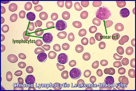 Chronic Lymphocytic Leukemia Ask Hematologist Understand Hematology