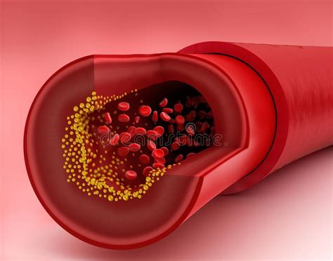 Cholesterol Plaque In Blood Vessel Stock Illustration Illustration Of