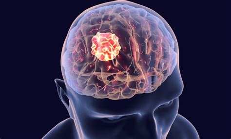 World Brain Tumor Day Causes And Symptoms Tata 1mg Capsules