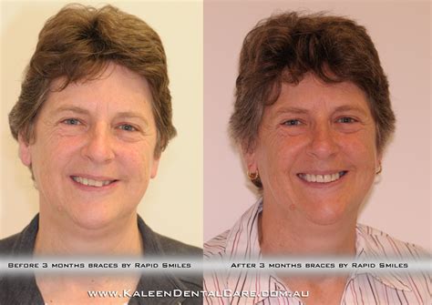 Facial Growth And Airways Kaleen Dental Care And Facial Aesthetics