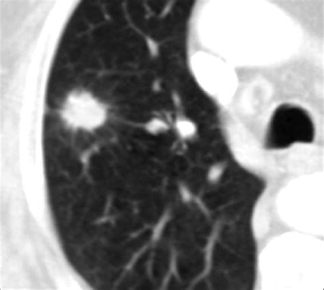 Pulmonary Nodule With Lobulated Margins Figure Benign Granuloma Download Scientific Diagram