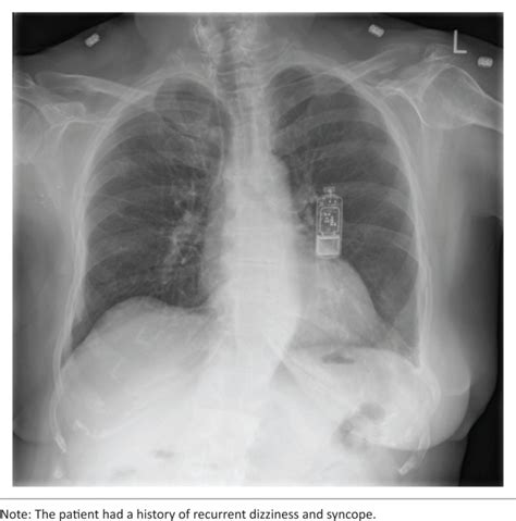 Chest Radiographs Of Cardiac Devices Part 1 Cardiovascular