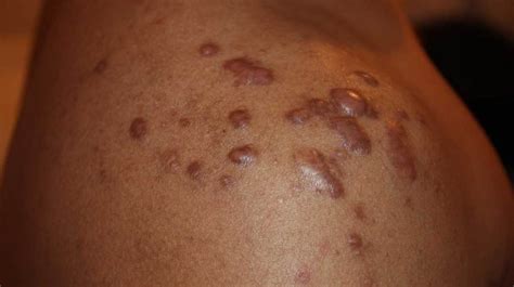 Whats Causing This Skin Lesion Su Oggi