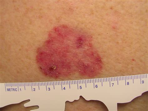 Squamous Skin Cell Cancer Hksyiqrrs