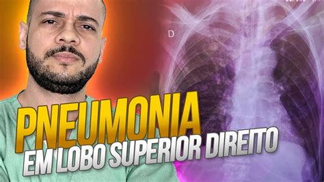 Pneumonia Do Lobo Pesado