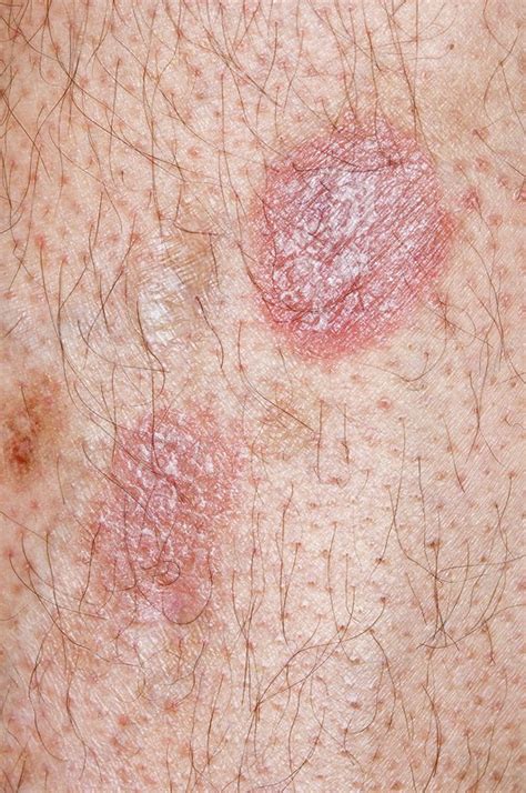Treated Psoriasis On The Leg Stock Image C0130976 Science Photo