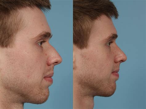 Rhinoplasty Before And After Photos Patient 231 Chicago Il Tlkm
