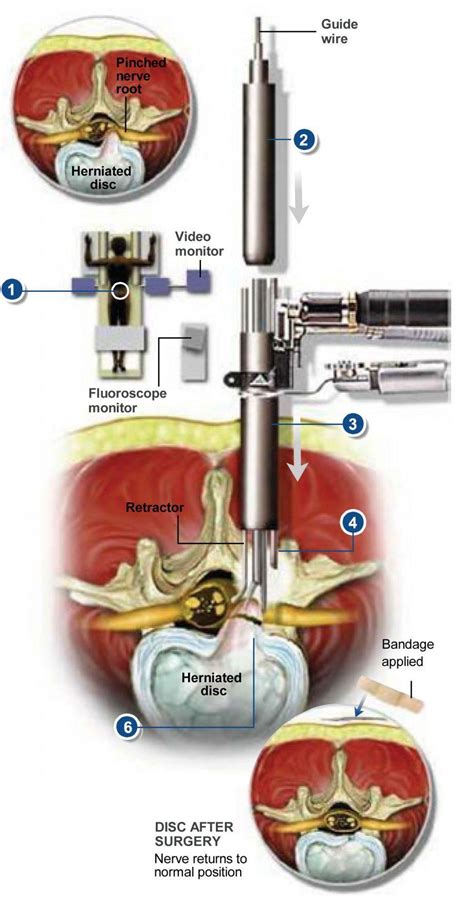 Micro Endoscopic Discectomy Plano Tx Advanced Spine Center