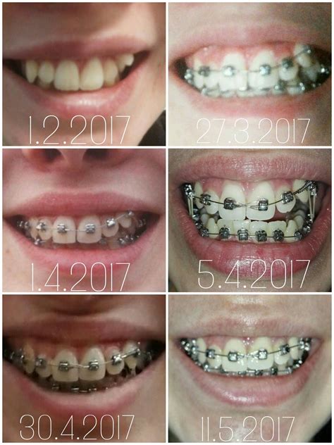 Only 3 Month Progress In 6 Pictures Teeth Braces Braces Tips