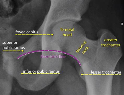 Traumatic Hip Dislocation What The Orthopedic Surgeon Wants To Know