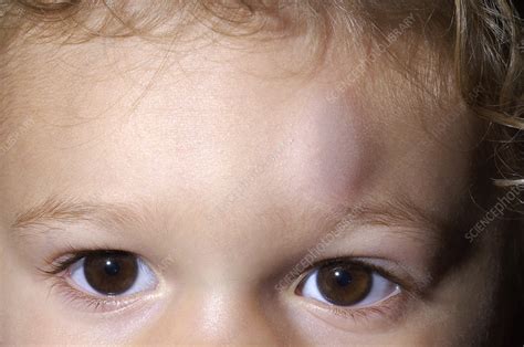 Bump On A Childs Head Stock Image M3301366 Science Photo Library