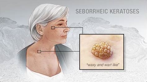 Seborrheic Keratosis Treatment Glasgow Ever Clinic