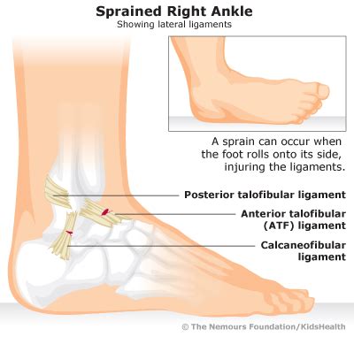 You may experience a broken foot during a car crash or from a simple misstep or fall. Ankle Sprains