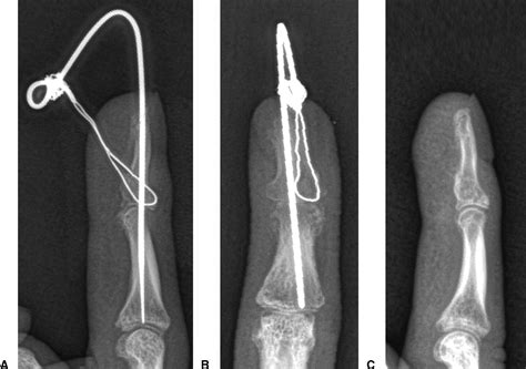 Pull Out Wire Fixation For Acute Mallet Finger Fractures With K Wire