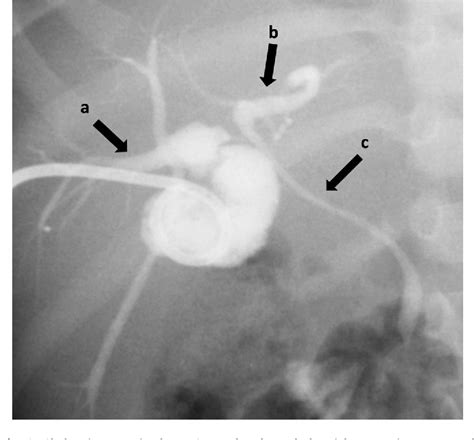 Figure 2 From The Use Of Laparoscopic Subtotal Cholecystectomy In A