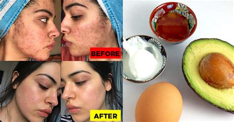 Diy Highly Effective Natural Acne Spot Treatment