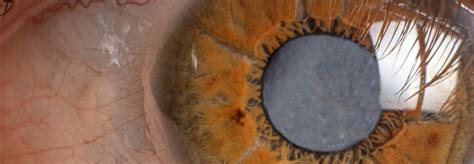 Lens Diseases Provisu