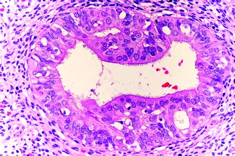 Pathology Outlines Endometrial Metaplasia