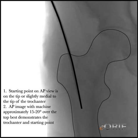 Intertrochanteric Femur Fracture Imhs 27245 Eorif