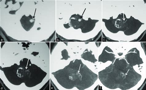 A F Serial Axial Section Of Computerized Tomography Angiogram Showing