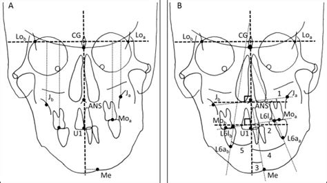 Determining The Midsagittal Reference Plane For Evaluating Facial