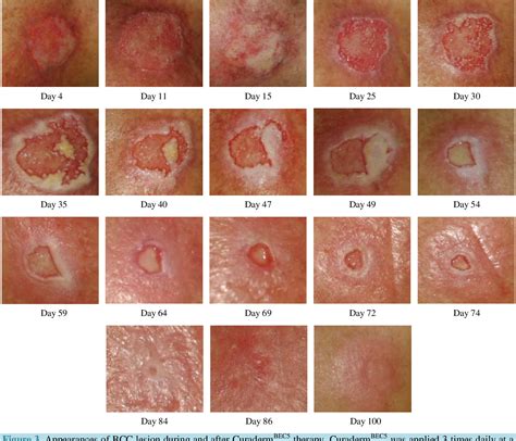 Pdf Treatment Of Skin Cancer With A Selective Apoptotic Inducing