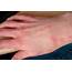 How To Get Rid Of Scabies  GetRidofThingscom