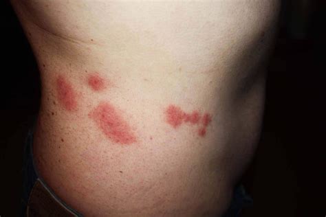 Bed Bug Bites Bed Bugs Bites Bed Bug Bites Pictures Do Bed Bug