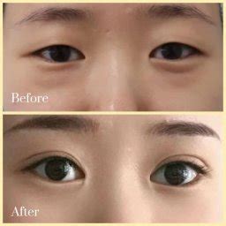 Eye Bag Removal Sydney Top Blepharoplasty Eye Lift Surgeons