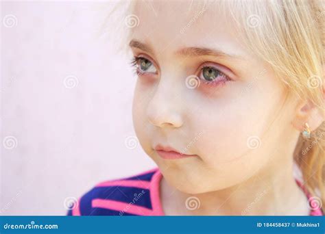 Pinkeye Conjunctivitis Infection On A Boy Doctor Check Up Eye Royalty Free Stock Photo