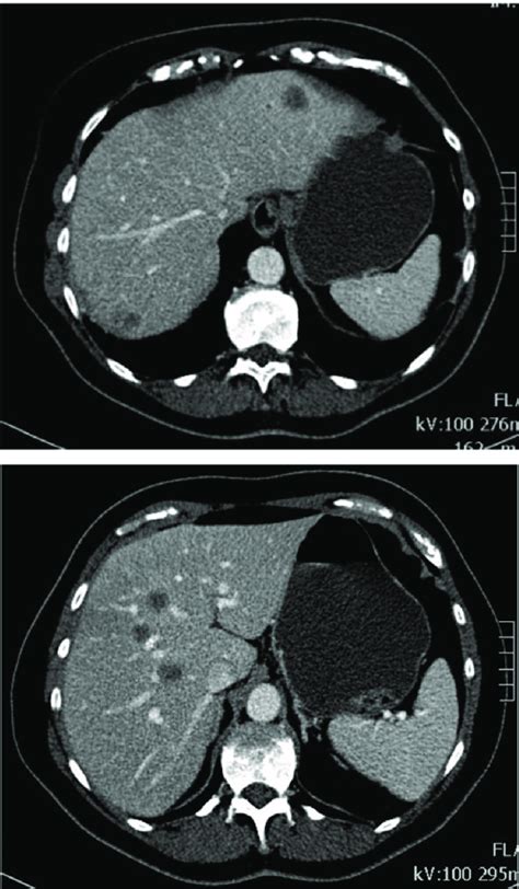 Contrast Enhanced Ct Abdomen In The Portal Venous Phase Multiple Focal