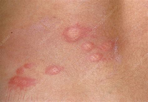 urticaria skin rash of the back of a patient stock image m280 0070 science photo library