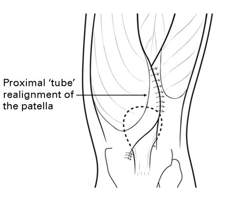 The ‘four In One Procedure For Habitual Dislocation Of The Patella In