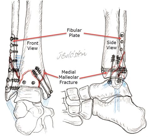 Ankle Fracture And Treatment Sports Medicine And Orthopedics