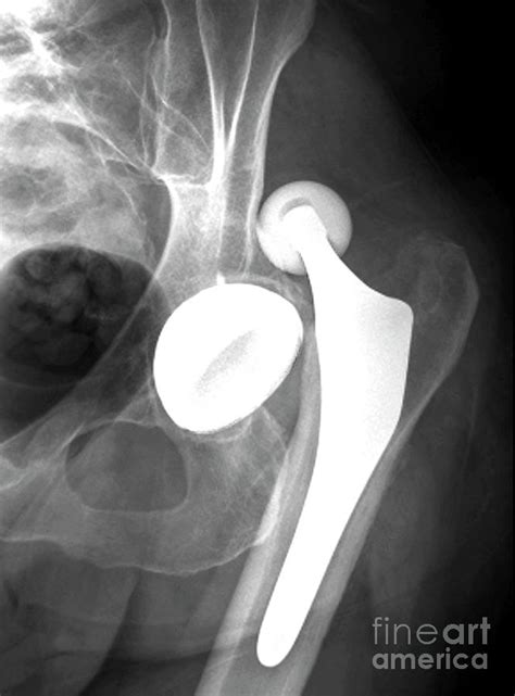 Dislocated Hip Replacement Photograph By Zephyrscience Photo Library