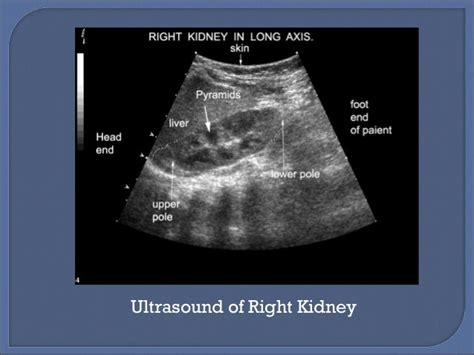 Radiological Anatomy Of Kidney Ureter And Bladder